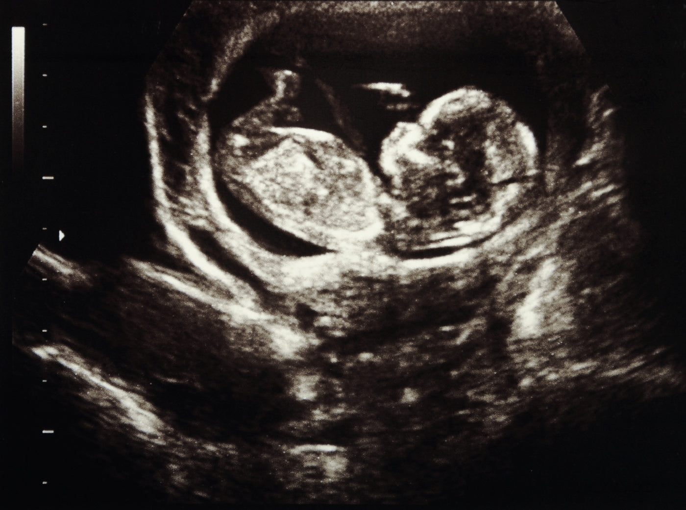 Thanks to ultrasound, it is possible to see how your baby grows during pregnancy. Whether an ultrasound is harmful? We will tell you!