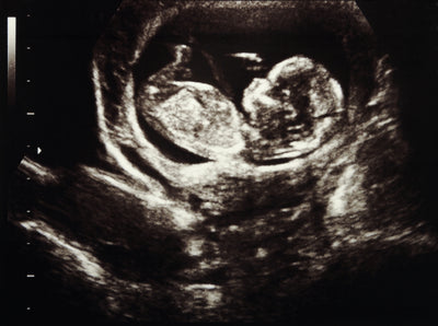 Everything you need to know about an ultrasound